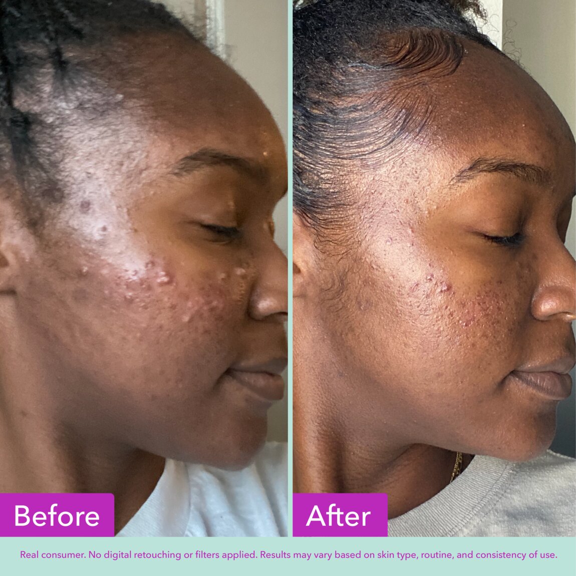 acne-foaming-cleanser-x5 zb_p.jpg